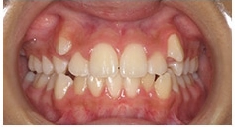 before and after