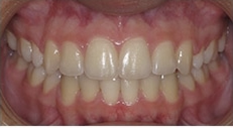 before and after